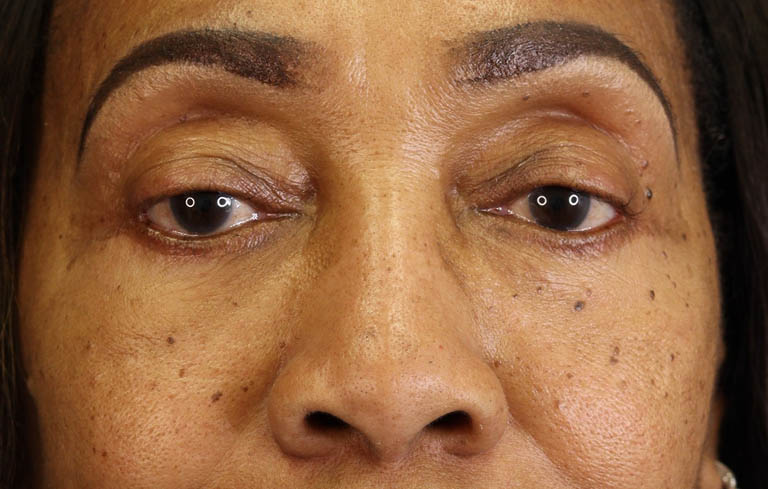 Blepharoplasty case #5732