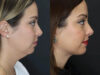 Facial Filler case #5993 slider thumbnail