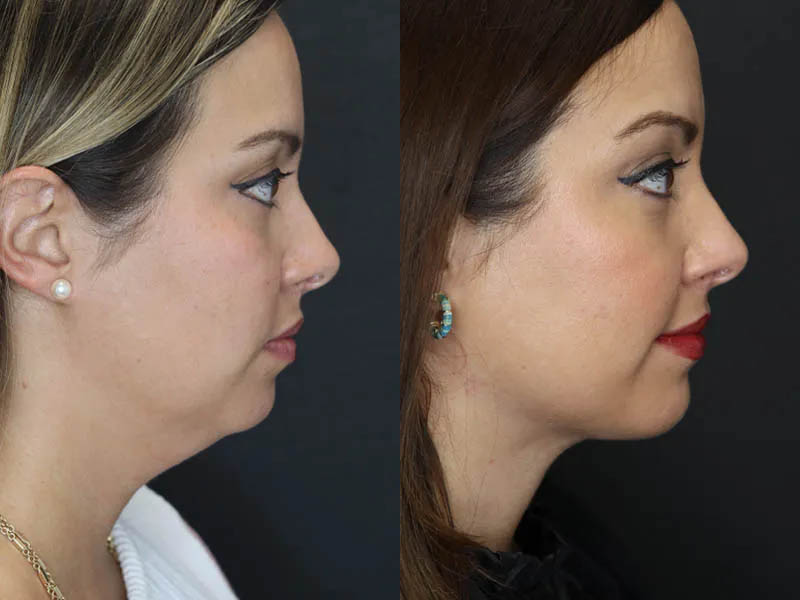 Facial Filler case #5993