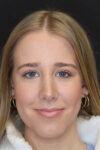 Rhinoplasty case #5794