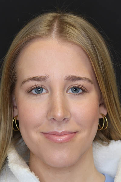 Rhinoplasty case #5794