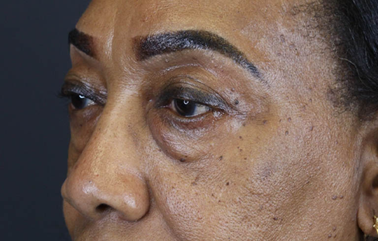 Blepharoplasty case #5732