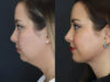 Facial Filler case #5993 slider thumbnail