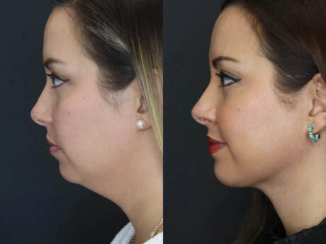 Facial Filler case #5993