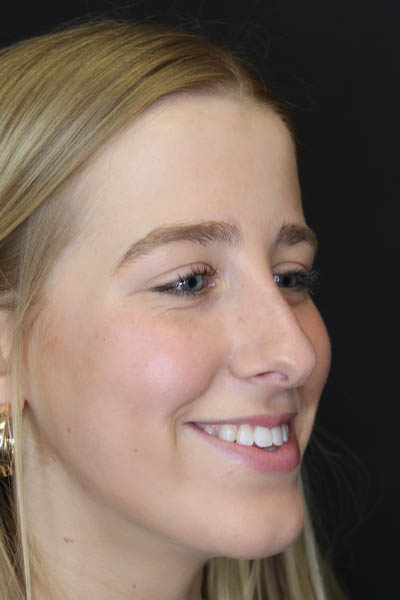 Rhinoplasty case #5794