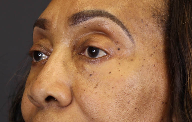 Blepharoplasty case #5732