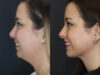 Facial Filler case #5993 slider thumbnail