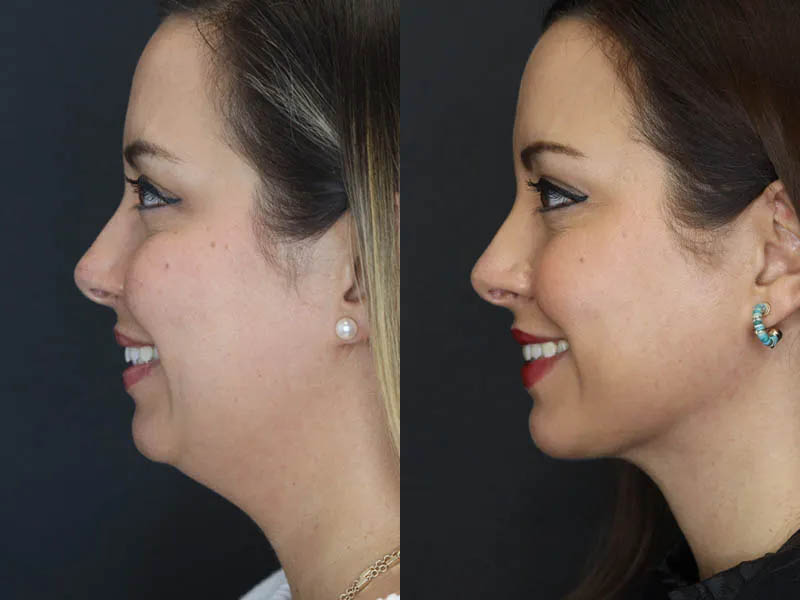 Facial Filler case #5993