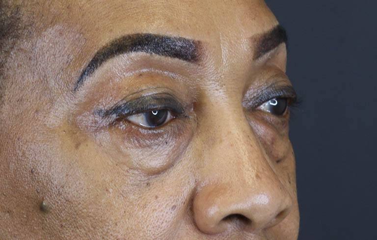 Blepharoplasty case #5732