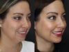 Facial Filler case #5993 slider thumbnail