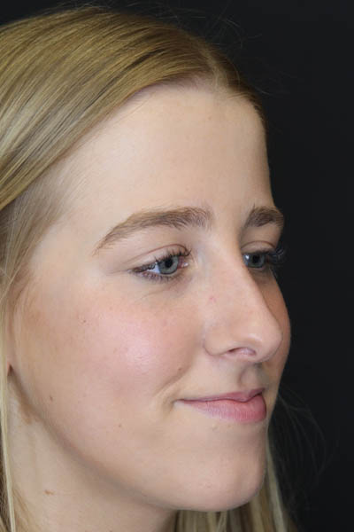Rhinoplasty case #5794