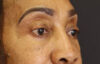 Blepharoplasty case #5732