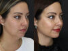 Facial Filler case #5993 slider thumbnail