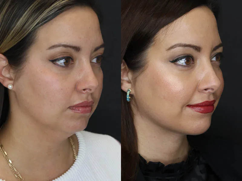Facial Filler case #5993