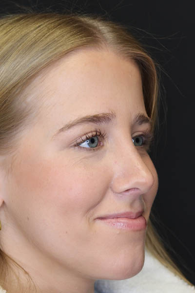 Rhinoplasty case #5794