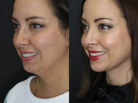 Facial Filler case #5993