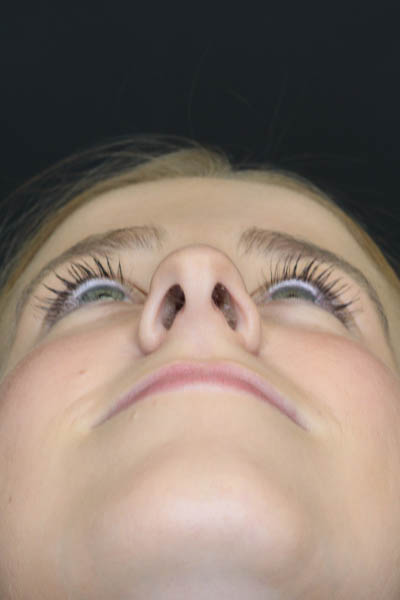 Rhinoplasty case #5794