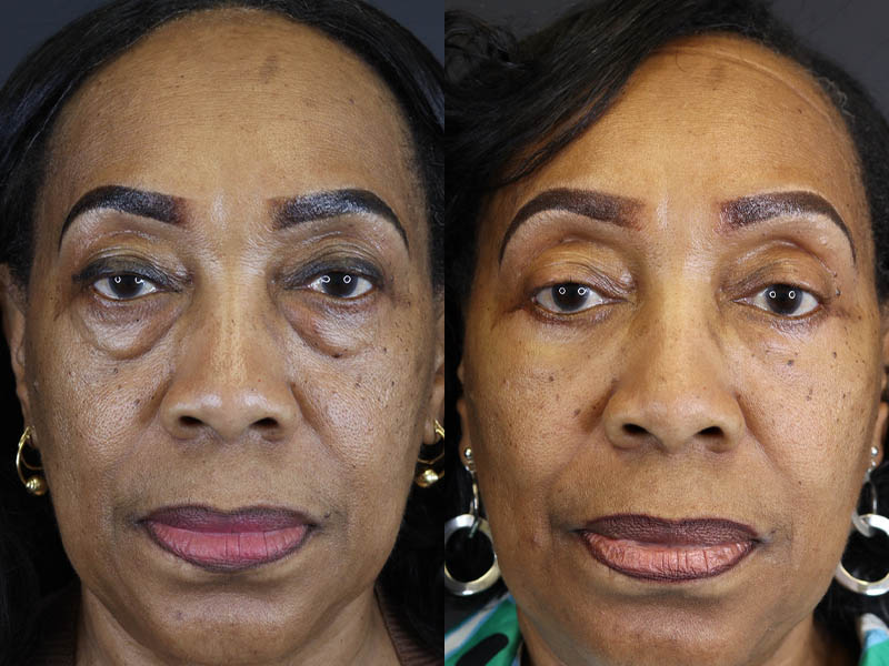 Fat Grafting case #5767