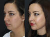 Facial Filler case #5993 slider thumbnail
