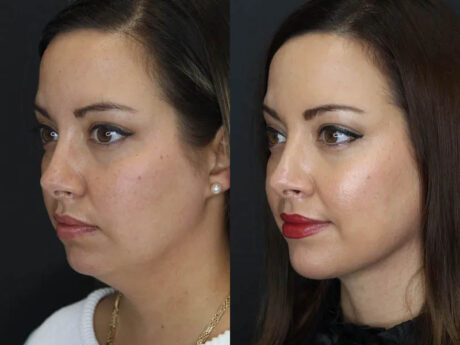 Facial Filler case #5993