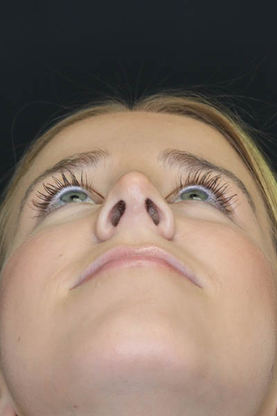 Rhinoplasty case #5794