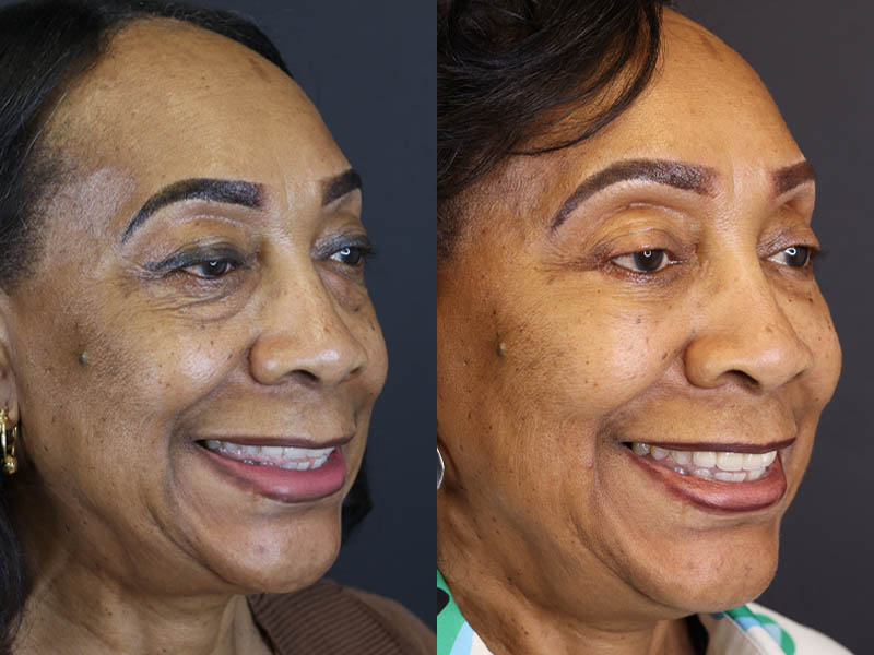 Fat Grafting case #5767