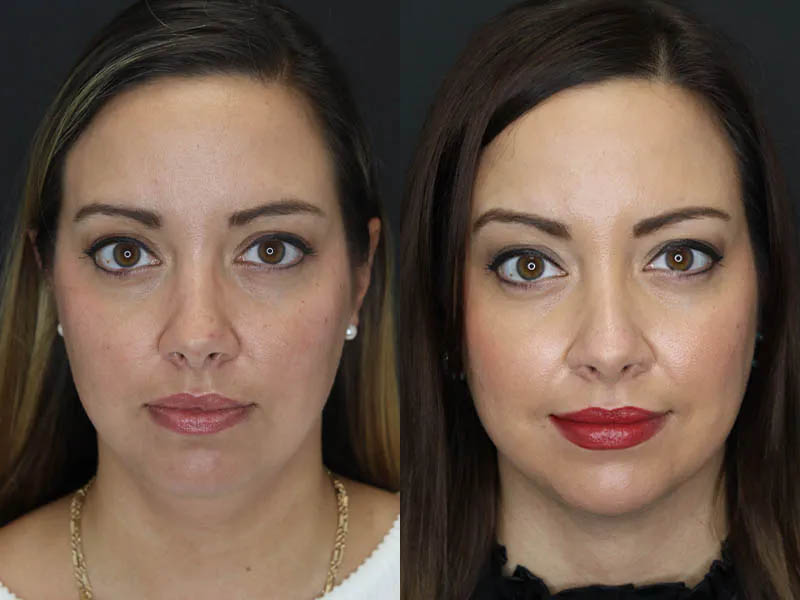 Facial Filler case #5993
