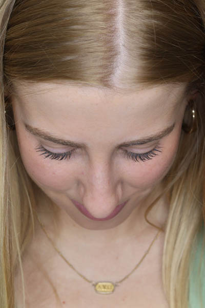Rhinoplasty case #5794