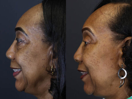 Fat Grafting case #5767