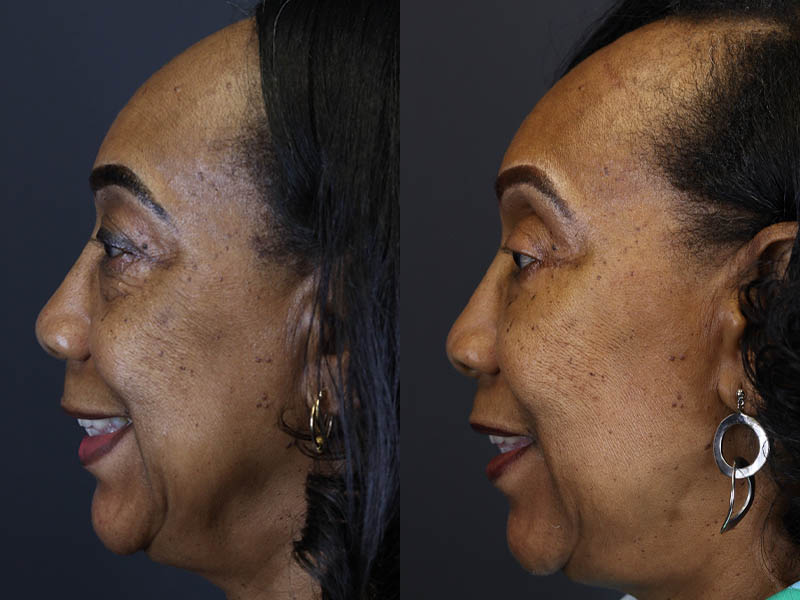 Fat Grafting case #5767