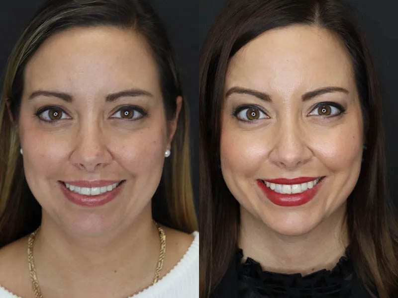 Facial Filler case #5993