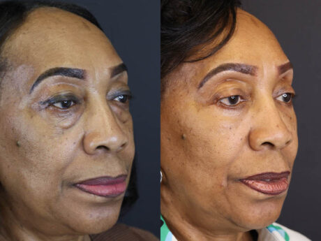 Fat Grafting case #5767