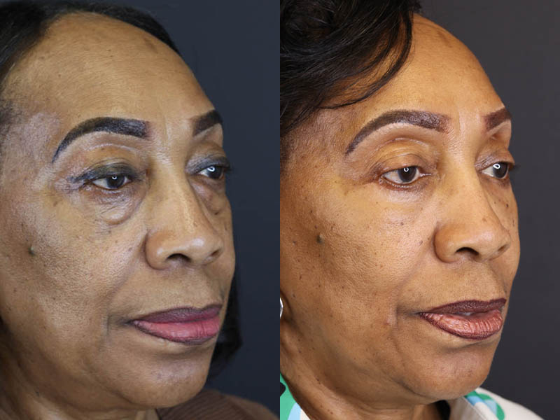 Fat Grafting case #5767