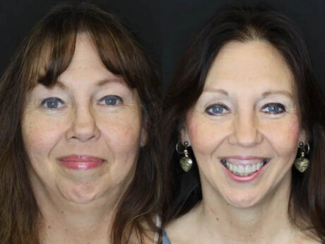 Revision Rhinoplasty case #6014