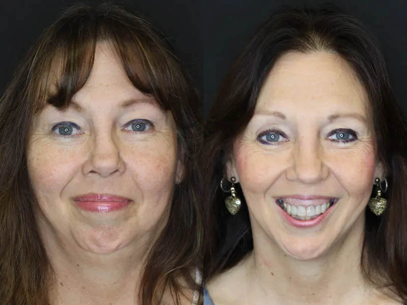 Revision Rhinoplasty case #6014