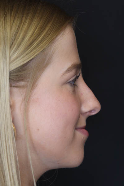 Rhinoplasty case #5794