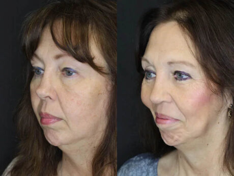 Revision Rhinoplasty case #6014