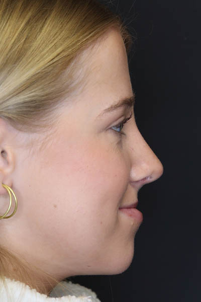 Rhinoplasty case #5794
