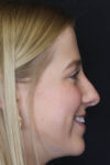 Rhinoplasty case #5794