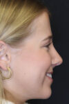 Rhinoplasty case #5794