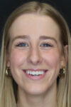 Rhinoplasty case #5794