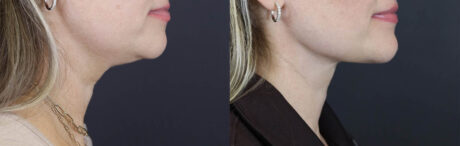 Facial Filler case #5978