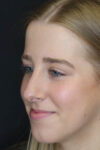 Rhinoplasty case #5794