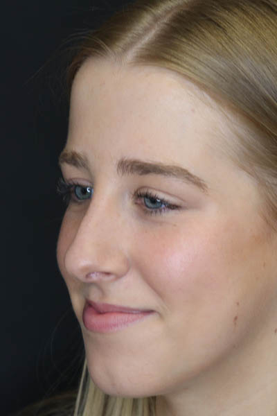 Rhinoplasty case #5794