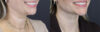 Facial Filler case #5978 slider thumbnail