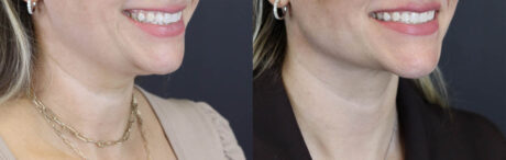 Facial Filler case #5978