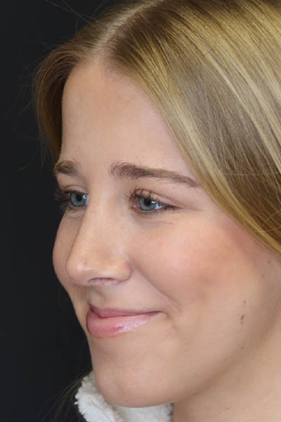 Rhinoplasty case #5794