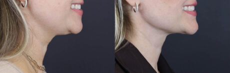 Facial Filler case #5978
