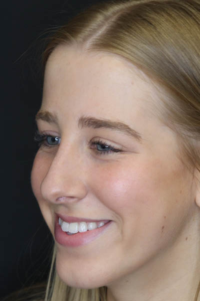 Rhinoplasty case #5794