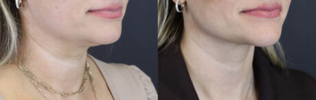 Facial Filler case #5978